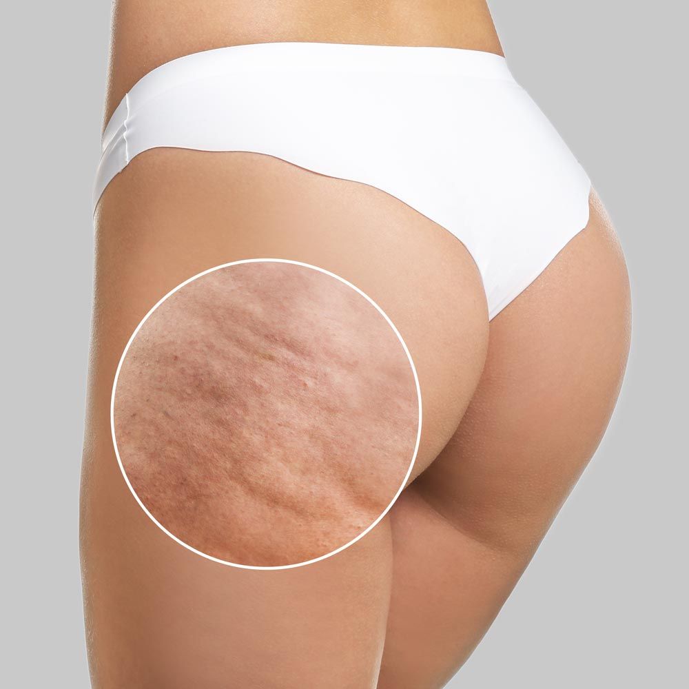 Final 3 Hours: 60%OFF🔥Naturals Cellulite Massage Oil